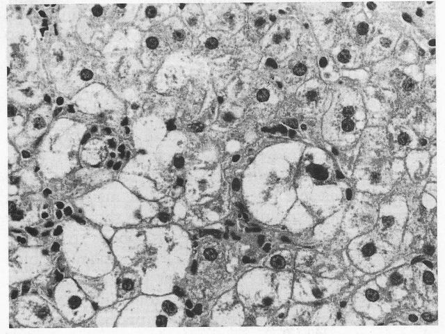 figura 2 - Esteatohepatitis no alcohlica. Balonizacin de hepatocitos, Cuerpos de Mallory.